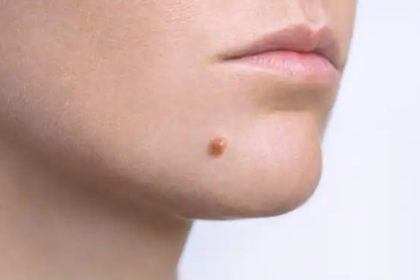 Warts Removal Home Remedies